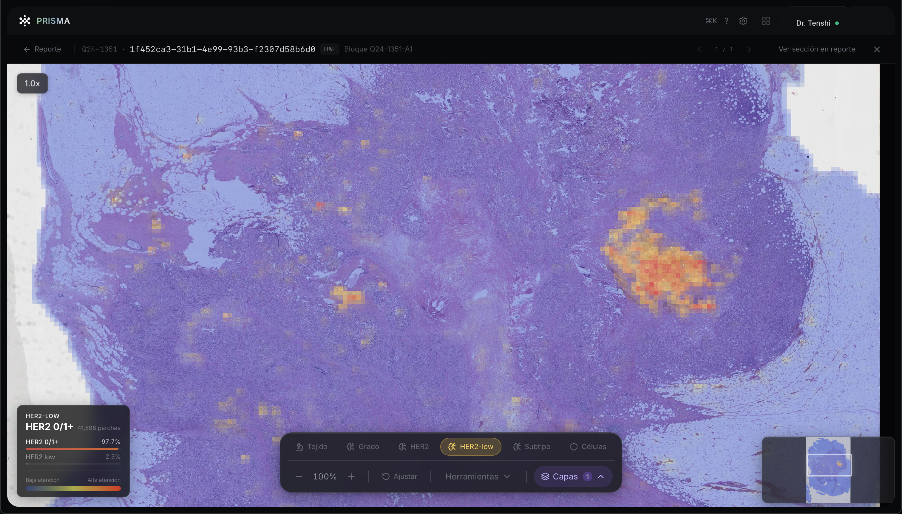 PRISMA — Overlay HER2-low con IA